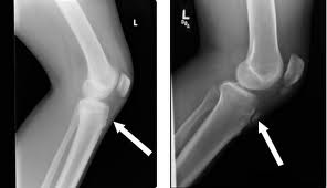 comment soigner la maladie d'osgood schlatter